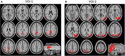 Differentiating Mild Cognitive Impairment, Alzheimer's Disease, and Dementia With Lewy Bodies Using Cingulate Island Sign on Perfusion IMP-SPECT
